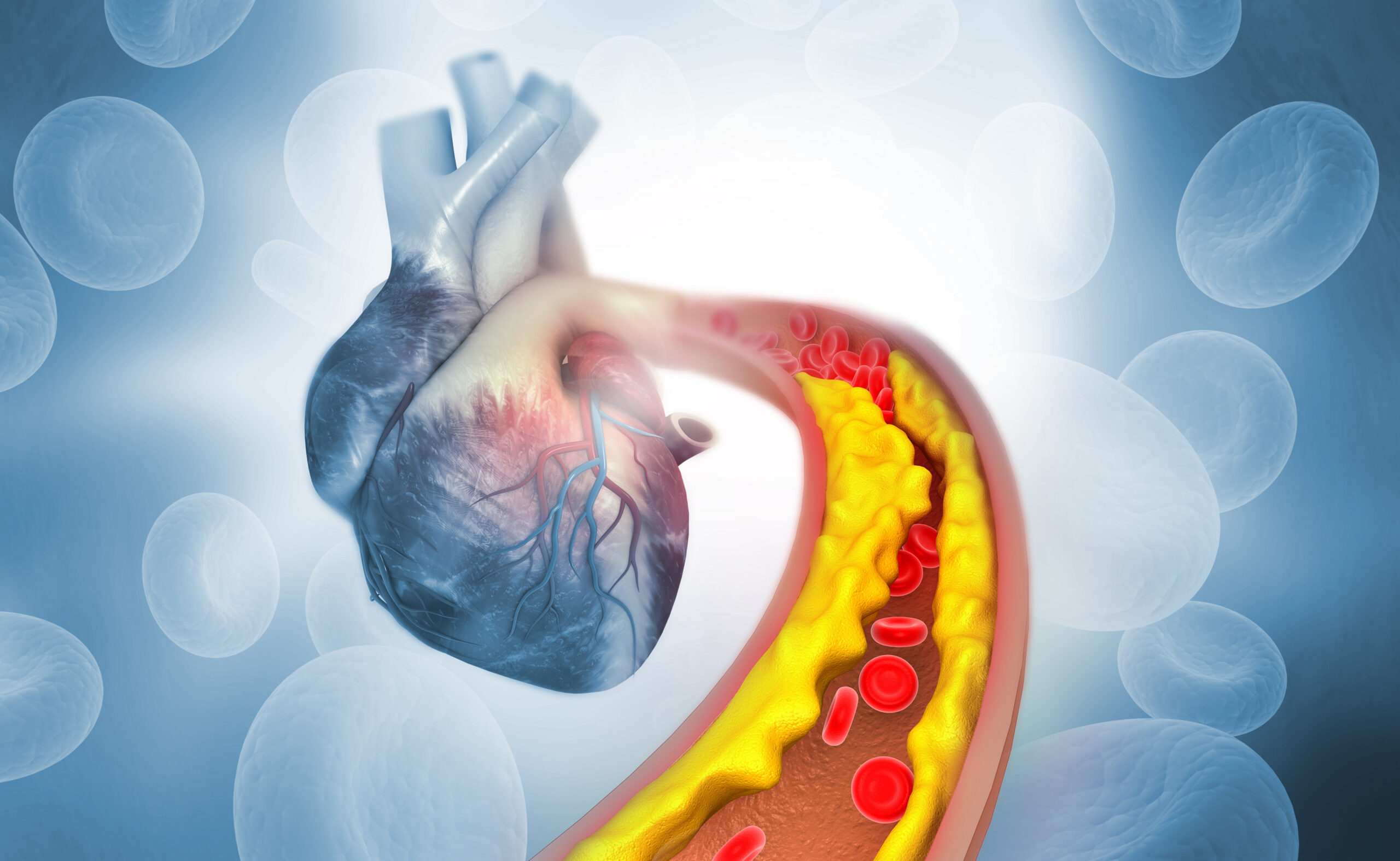 Cholesterol plaque in artery with Human heart anatomy. 3d illustration